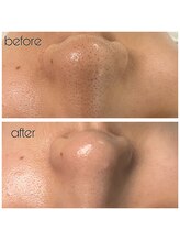 シェクラ(SHECIA)/毛穴の黒ずみ除去★