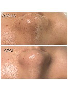 シェクラ(SHECIA)/毛穴の黒ずみ除去★