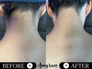 アングレイス(Anngrace)/【全身脱毛うなじ】Before/After