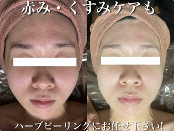 ホワイトアクア 梅田本店(WHITE AQUA)/ハーブピーリング/大阪/梅田