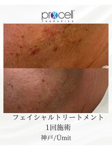 ユミト(Umit)/プロセルフェイシャル