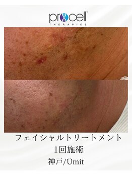 ユミト(Umit)/プロセルフェイシャル