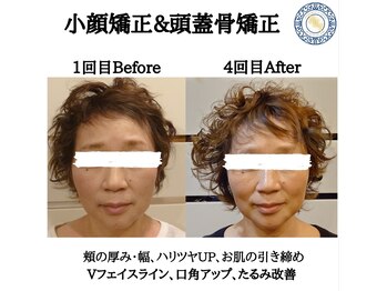 RKY/小顔矯正&頭蓋骨矯正4回(50代)