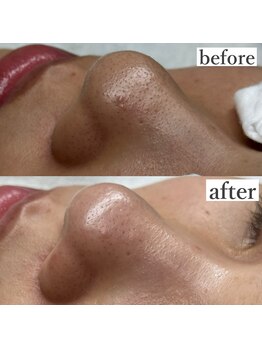 ライカブルー(RaicA BluE)/施術写真　before-after