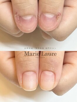 マリーロール 淀屋橋本店(Marie Laure)/自爪育成/深爪矯正/ネイルケア