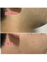 カミングオーツー(髪ingO2)/メンズひげ脱毛