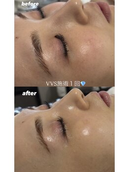 デュールイースト(Duul East)/VVS ダイヤモンドピーリング