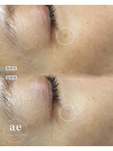 アエ(ae)/スポットクリア