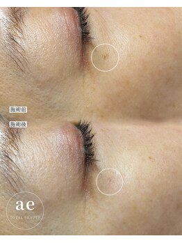 アエ(ae)/スポットクリア