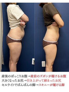 こうぞう整体院/産後骨盤矯正Before&After