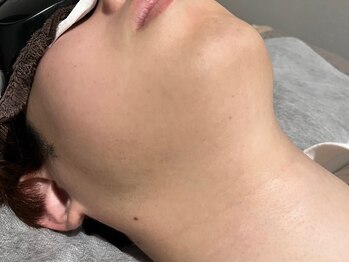 ブレイヴ(BRAVE)の写真/【ひげ脱毛全体1回￥1000】青ひげを解消して清潔感UP☆リピーター続出◎完全個室で人目も気にならない！