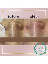 メイト(mate)/毛穴エクストラクションtete式