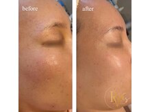 ラヴィス(RAVIS)/気になる細かい毛穴も綺麗に♪