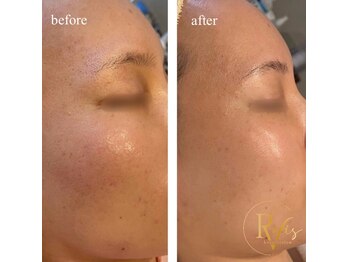 ラヴィス(RAVIS)/気になる細かい毛穴も綺麗に♪