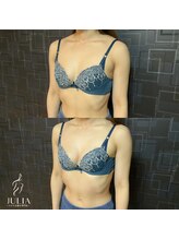 ジュリア(JULIA)/【バストアップ/育乳　症例】