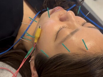 整体院ストック(Stock)の写真/【美容鍼導入★顔の左右差や、むくみを解消し小顔に!】丁寧なカウンセリングと施術でお客様に寄り添います!