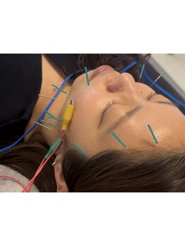 鍼灸施術を受けたい