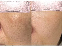 モガナ(mogana)/もやっとした薄いお悩みにも◎