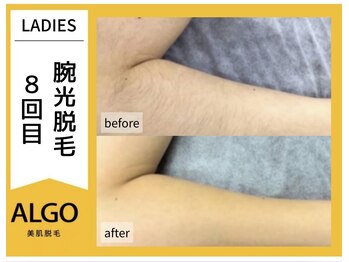 アルゴ 福井店(ALGO)/腕光脱毛 8回目