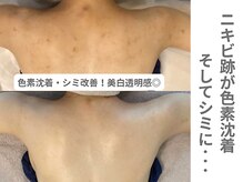 ピュアノア 三木店/背中ピーリング　三木|小野|西脇