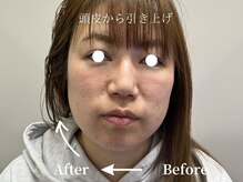 ミスティア(mistia)/エステ【スカルプ】1回/片側10分