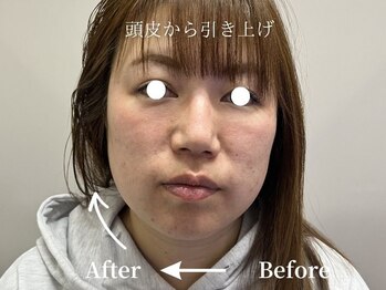 ミスティア(mistia)/エステ【スカルプ】1回/片側10分