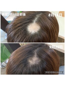 鍼灸チャンドラ(鍼灸Chandra)/毛根トラブルにも鍼