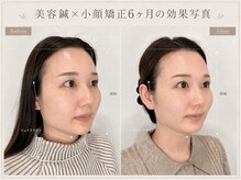 カドモリ 心斎橋(KADOMORI)の雰囲気（美容鍼/大阪美容鍼/心斎橋美容鍼/本町美容鍼/四ツ橋/小顔矯正）