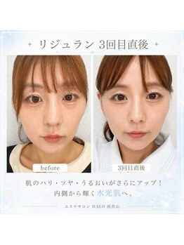 ハロ 南青山(HALO)の写真/“ただ小顔にする”だけじゃない、自然でバランスの良い仕上がりを追求♪