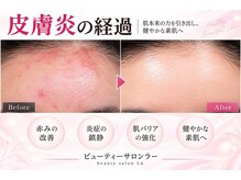 ラー(La)の雰囲気（細胞論に基づいた特別メニューで皮膚トラブル解消）