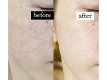 ハーブピーリング♪肌質改善、ニキビケア、シミにお悩みの方へ◎