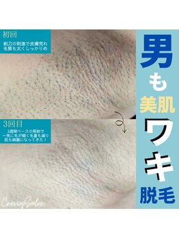 クレヴィー(Creviy)/ワキ脱毛（3回目照射の男性）