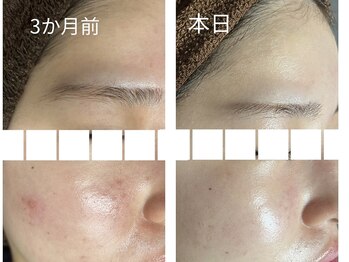 リボーン(REBORN)/ハーブピーリング