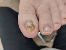 爪切り屋 足楽/肥厚・変色爪★【after】