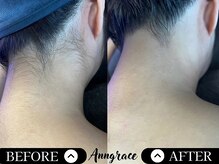 アングレイス(Anngrace)/【全身脱毛うなじ】Before/After