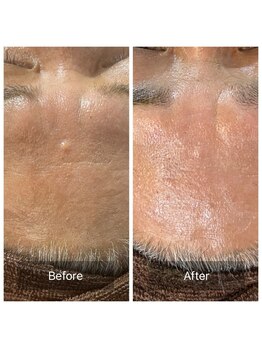 デイジー/MENSグリーンピール2回目/ニキビ