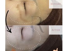 リヴェーヌ 呉羽店(Riverne)/頬骨のシミケアも◎