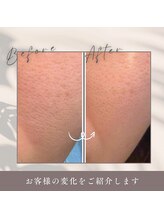 キレナル(KIRENAL)/ラミネーションピール