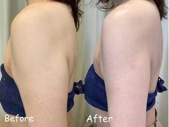 ボディーリセット 勝どき/≪脂肪冷却 before/after≫