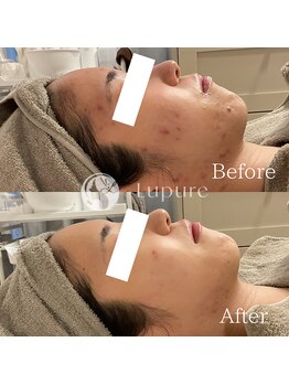 ルプレ(Lupure)/ハーブピーリング9回目