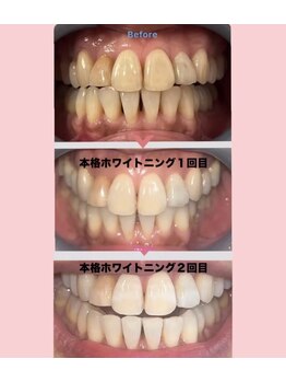 コトリト(Cotorito)/本格ホワイトニング2回