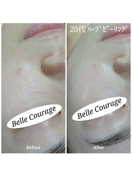ベルクラージュ(Belle Courage)/20代　毛穴の開き・赤み