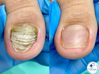 プラスワンフット 本厚木(+1 Foot)/変形・肥厚した爪を正常な爪へ