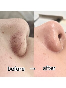 アンジェ(Ange)/毛穴洗浄コース