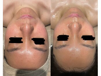 インチャント(enchant)/日焼け後ケアは早ければ早いほど