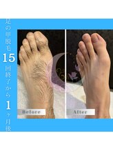 ルーチェ(Luce)/メンズ 足の甲 ビフォーアフター