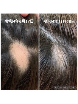 鍼灸チャンドラ(鍼灸Chandra)/気づいたらお早めにご相談を