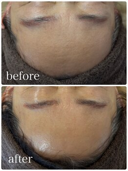 トレア(TREA)/ラミネーションピール/毛穴