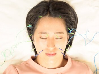 ハリ ヴァカンス(Hari Vacances)の写真/国家資格者による美容鍼◎お顔の状態に合わせたオーダーメイド施術