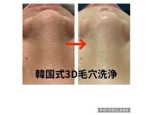 韓国式3D毛穴洗浄！！認定サロン毛穴のお悩み解消☆彡